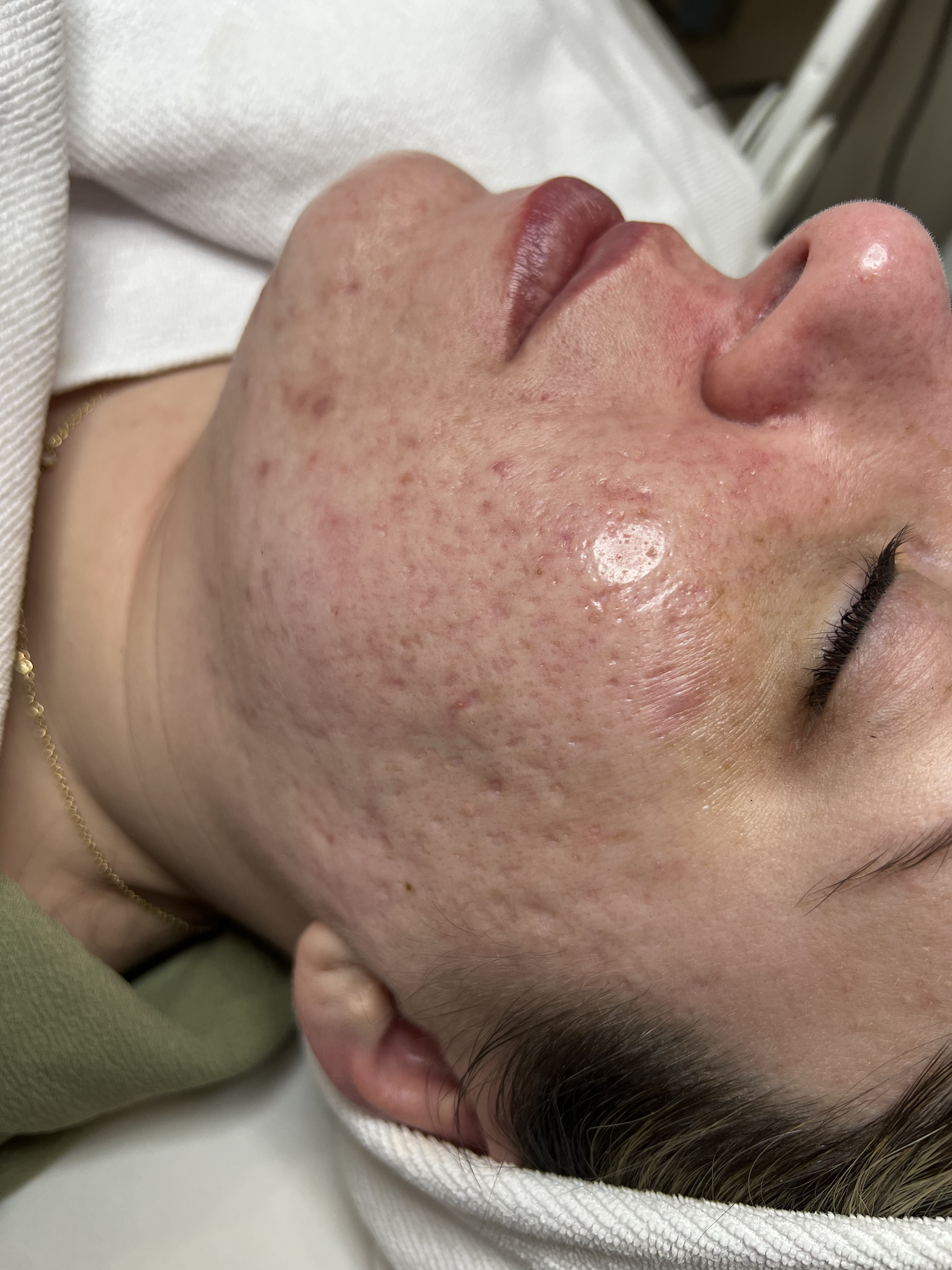After close-up of a client's face with visible skin conditions including scaring