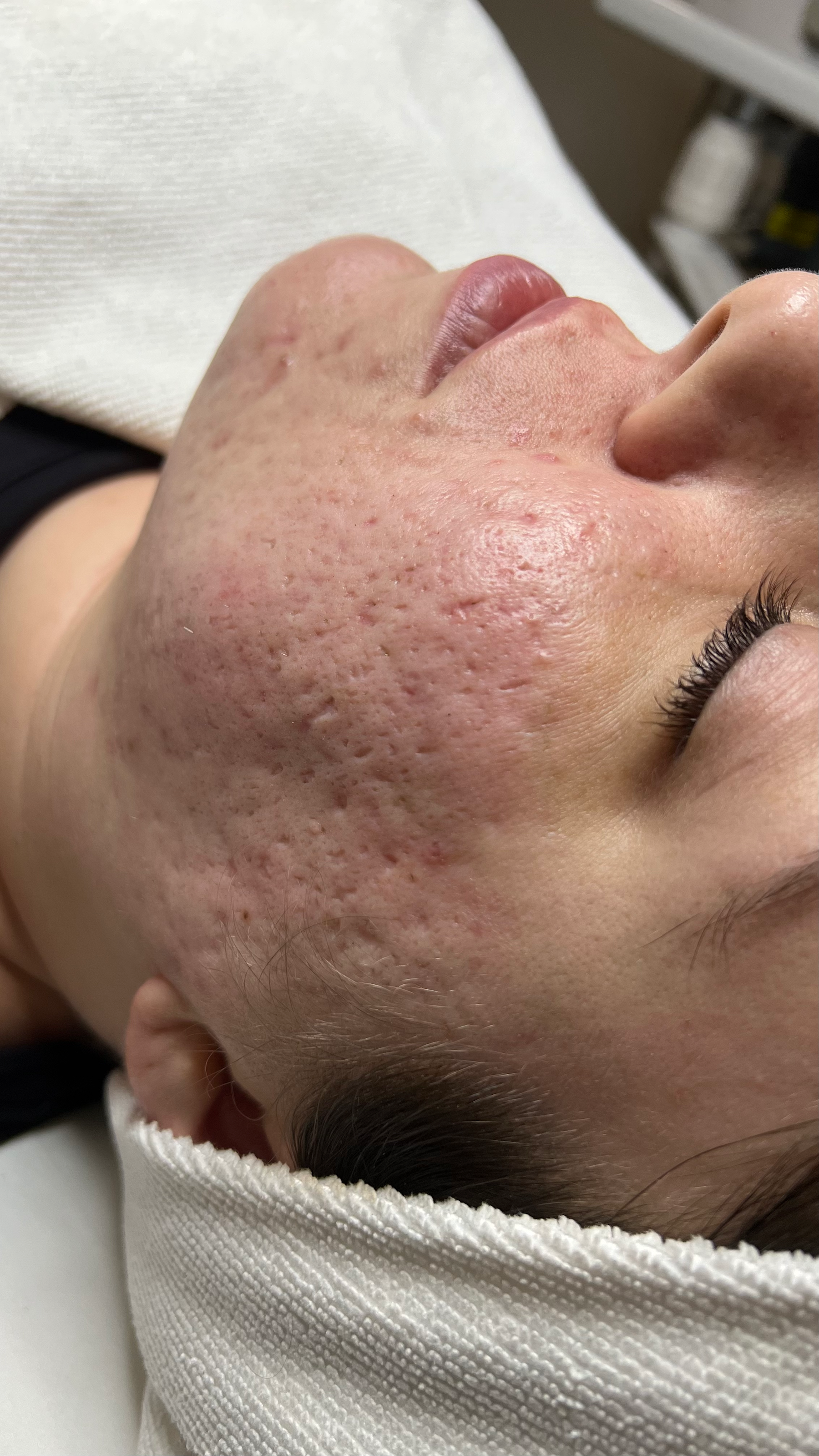 Before close-up of a client's face with visible skin conditions including scaring